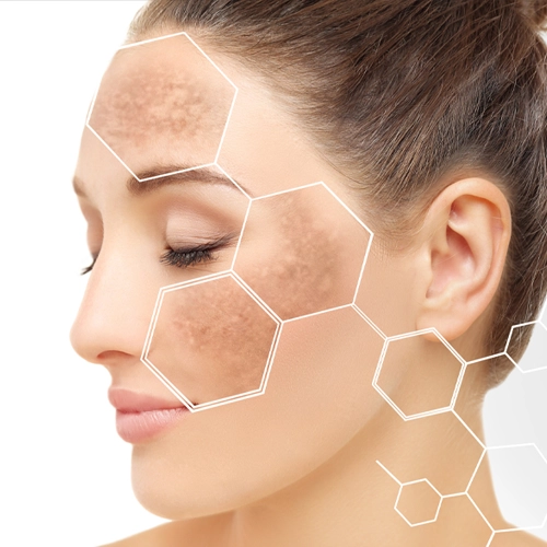 Kwasy na przebarwienia – które są najskuteczniejsze?