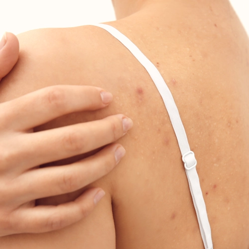 Trądzik na plecach i dekolcie - jak pozbyć się pryszczy na plecach? Polecane kosmetyki