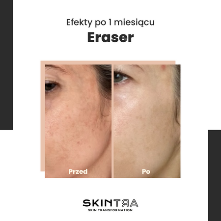 SkinTra - Eraser - Serum na Przebarwienia z Witaminą C 10% - 30ml 
