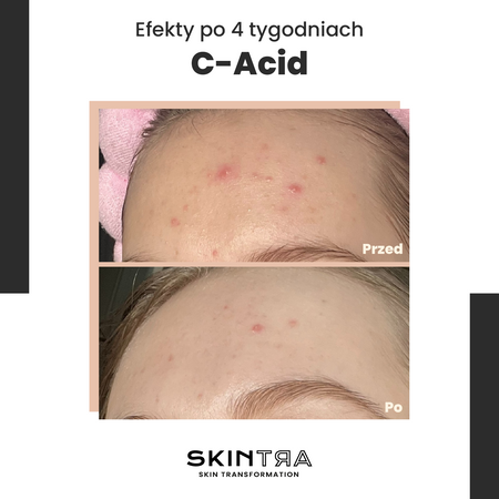 SkinTra - C-Acid - Kwasowa Kuracja z Witaminą C - 30ml - OUTLET