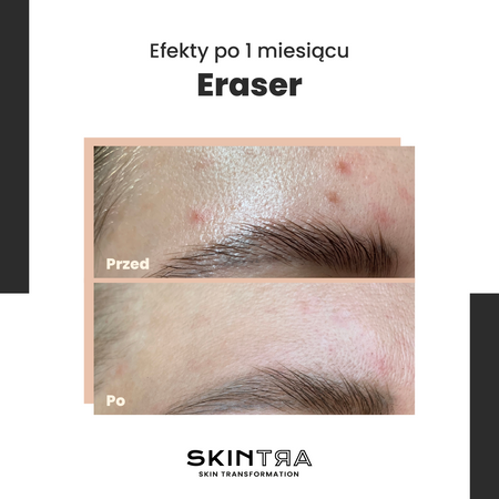 SkinTra - Eraser - Serum na Przebarwienia z Witaminą C 10% - 30ml 