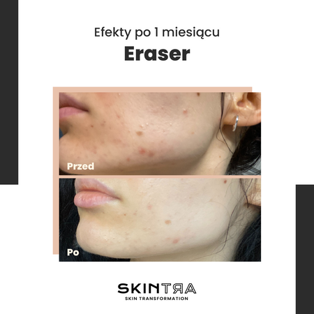 SkinTra - Eraser - Serum na Przebarwienia z Witaminą C 10% - 30ml 