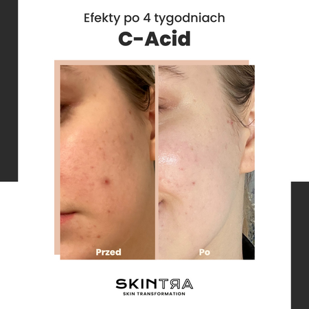 SkinTra - C-Acid - Kwasowa Kuracja z Witaminą C - 30ml - OUTLET