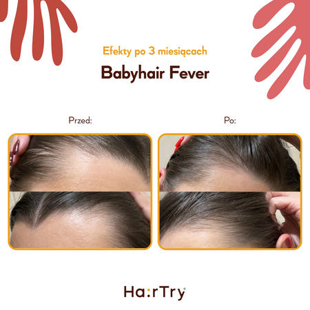HairTry - Babyhair Fever - Wcierka Rozgrzewająca na Porost Włosów - 100ml 	