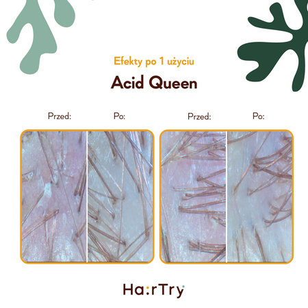 HairTry - Acid Queen - Trychologiczny Peeling Kwasowy do Skóry Głowy - 100ml