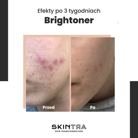SkinTra - Brightoner - Całoroczny Tonik Kwasowy 9% - 100ml